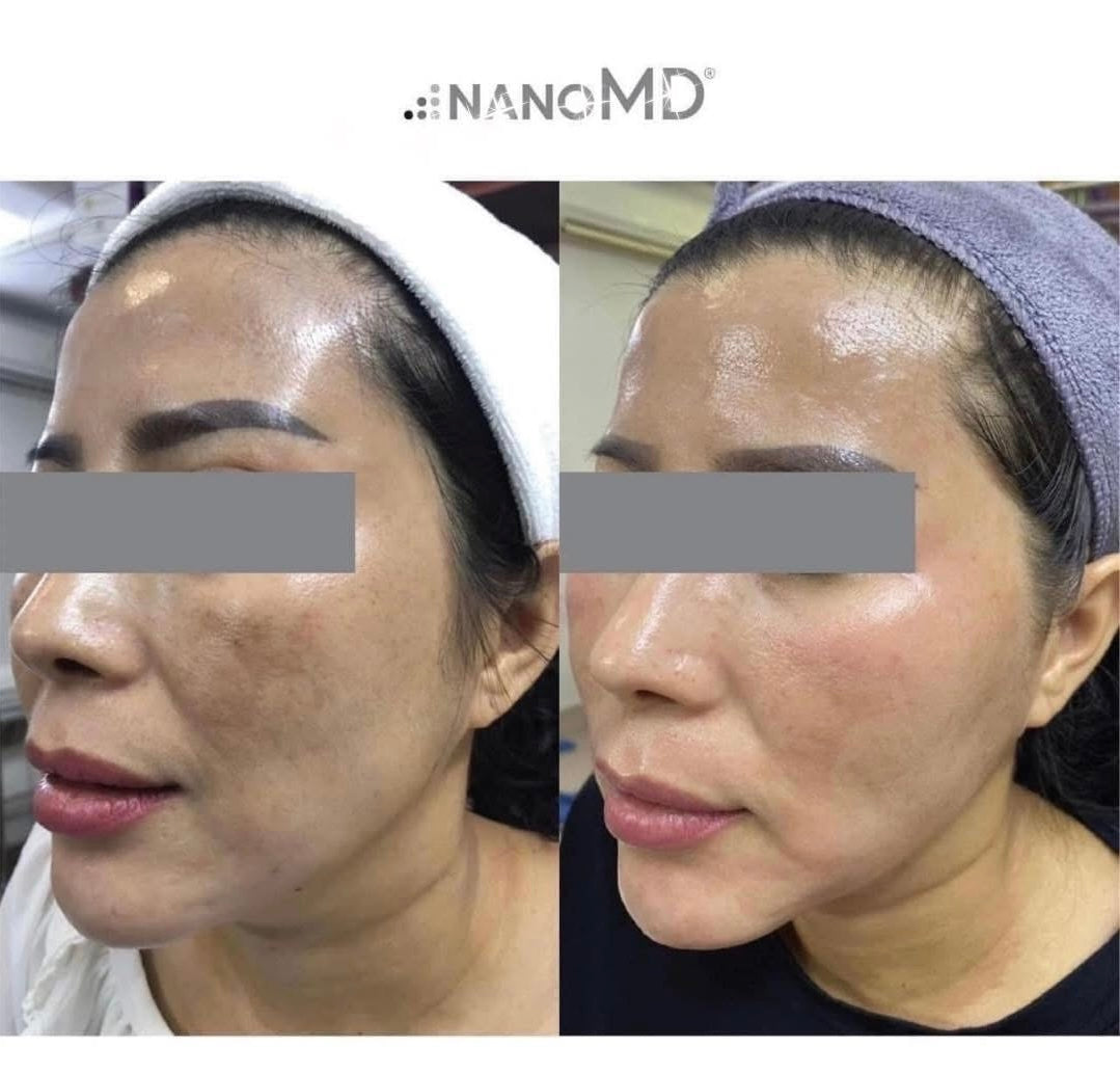 KEM LÀM GIẢM THÂM NÁM, SÁNG DA NANOMD CYNTRA ADVANCED PIGMENT CORRECTOR 20ML (HỘP) NEW VERSION