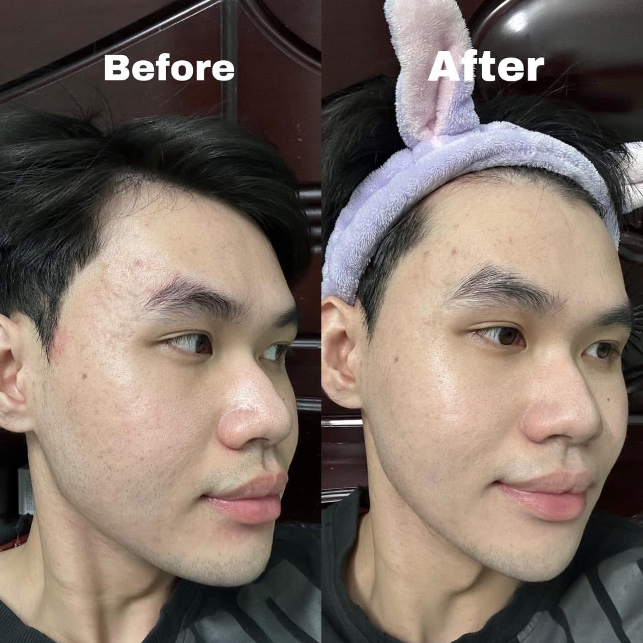 KEM CHỐNG NẮNG MARTIDERM MẪU MỚI BẢN THƯỜNG