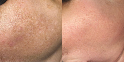 AnteAGE Pro Serum + Accelerator System